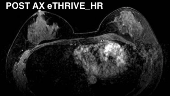 MR Bilateral Breasts WWO Protocol | OHSU